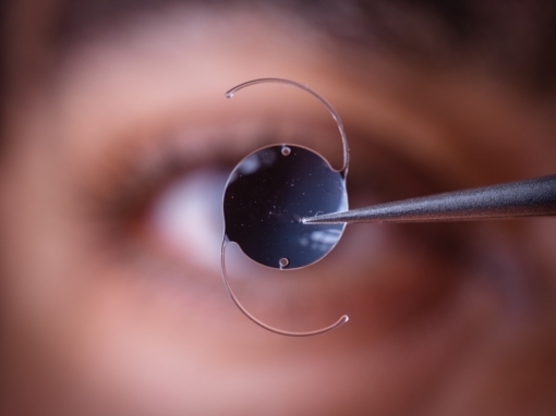 Why You Need A Lens Implant (IOL) With Cataract Surgery
