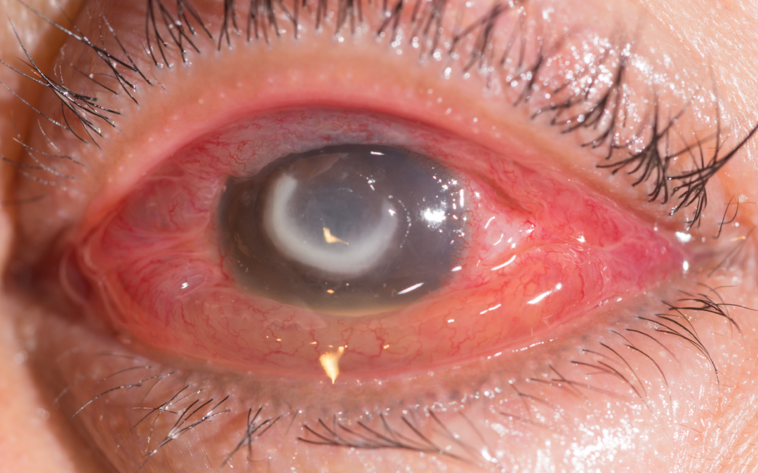 Contact Lenses and Eye Infections: A Hidden Risk