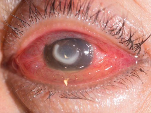 Contact Lenses and Eye Infections: A Hidden Risk
